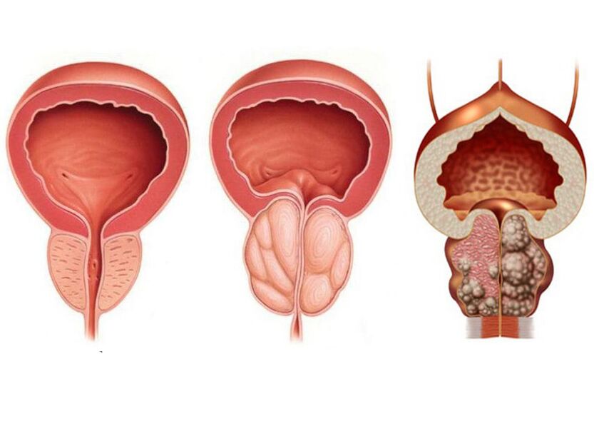 etapas da prostatite e a necesidade de usar plenamente a prostavit